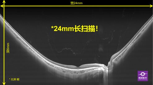 圖湃醫(yī)療亮相2021中國(guó)眼底病論壇 24mm血流成像技術(shù)引領(lǐng)眼底診斷新高度